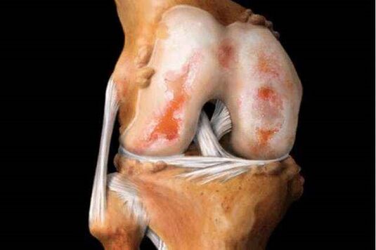 Schäden am Kniegelenk mit Arthrose
