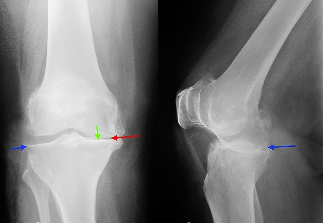 Röntgenbild einer Arthrose des Kniegelenks