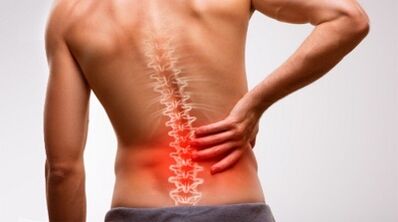 Anzeichen und Symptome einer Osteochondrose der Lendenwirbelsäule