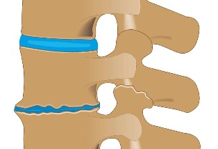 Bandscheibenschaden mit Osteochondrose