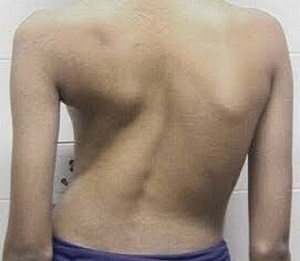 Skoliose als Ursache von Rückenschmerzen