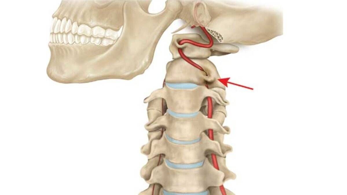 Osteochondrose der Halswirbelsäule