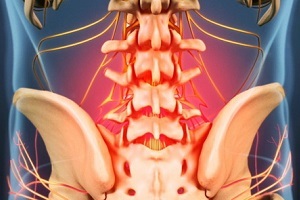 Ursachen und Symptome der Osteochondrose