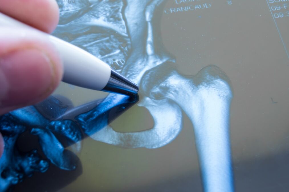 Arthrose des Hüftgelenks im Röntgenbild