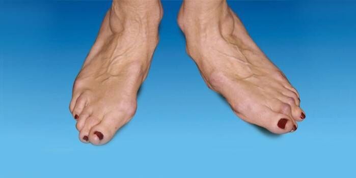 Fußfehlstellung bei Sprunggelenksarthrose