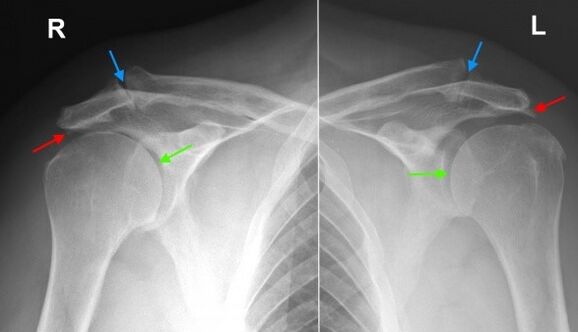 Röntgen der Schultergelenke